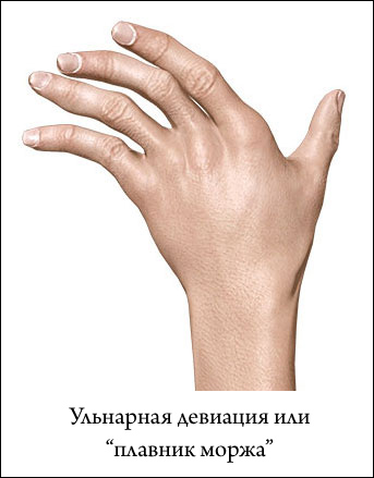 ульнарная девиация кистей
