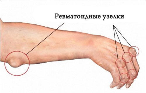 ревматоидные узелки